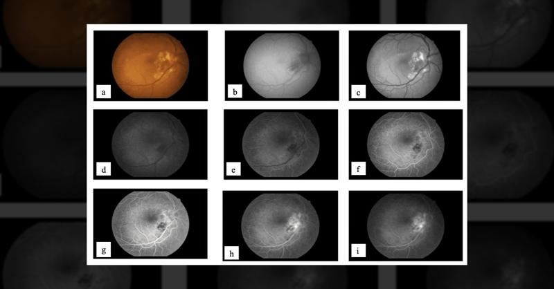 <p>Management of Peripapillary Choroidal Neovascular Membrane in a 60-Year-Old Woman</p>