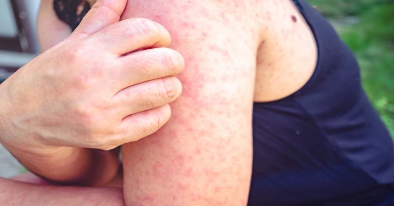 <p>Evaluating Beremagene Geperpavec (B-VEC) for Dystrophic Epidermolysis Bullosa</p>