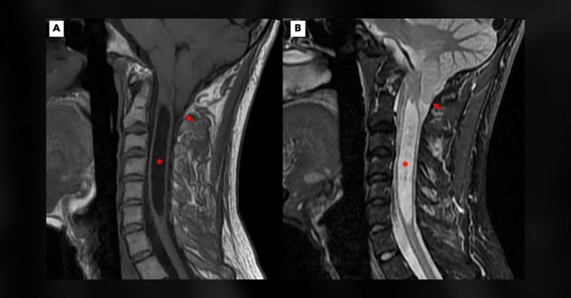 What Could Be the Cause of Upper Extremity Weakness and Scapular Winging?