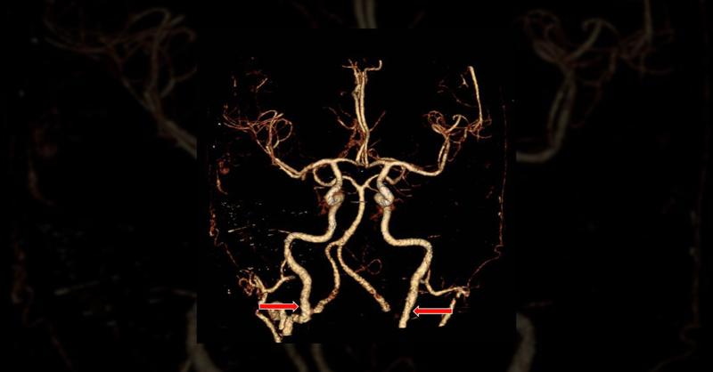 <p>Blurred Vision, Disorientation, Optic Disc Edema and Hemorrhage In Woman With Hypertension</p>