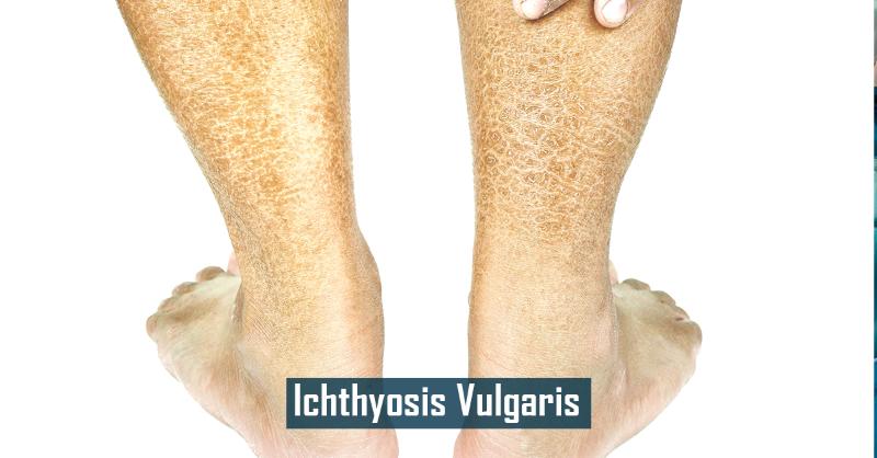 Case of Teenager with Ichthyosis Vulgaris