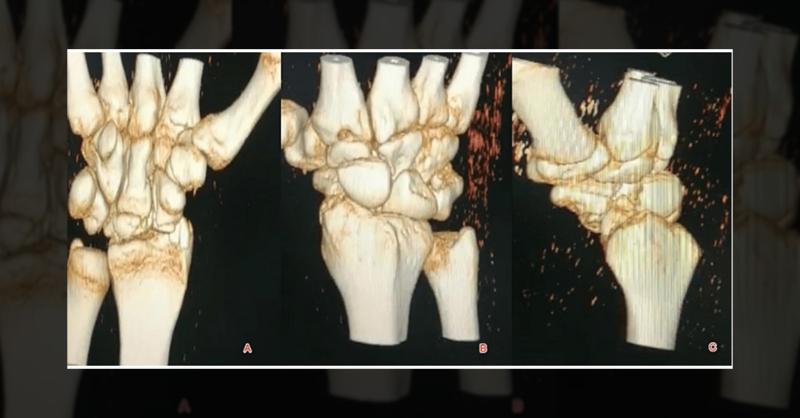 <p>Best-Suited Treatment Approach for Palmar Trans-scaphoid Perilunar Dislocation in an Adult Man</p>