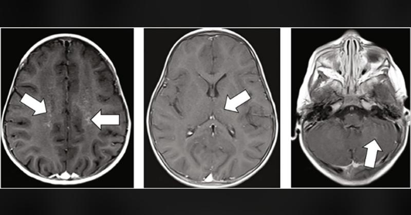 Meningoencephalitis Diagnosis in a Truncal Ataxia Presented Infant…The MRI Image Conceals the Cause