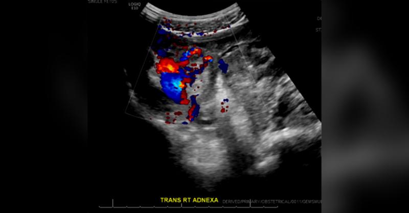 A 22-year-old Woman with Partial Molar Pregnancy