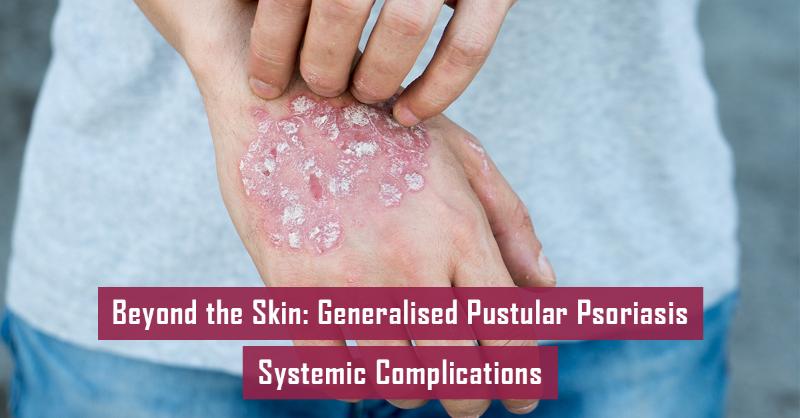 <div>Multi-Organ Complications in Generalised Pustular Psoriasis </div>