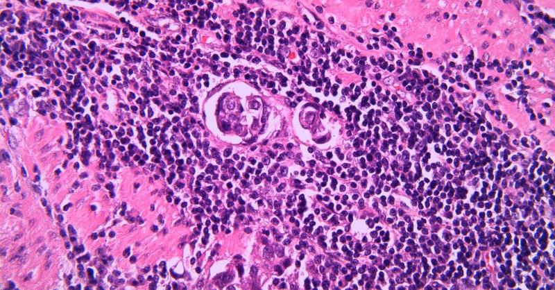 Enfortumab Vedotin for Locally Advanced or Metastatic Urothelial Cancer
