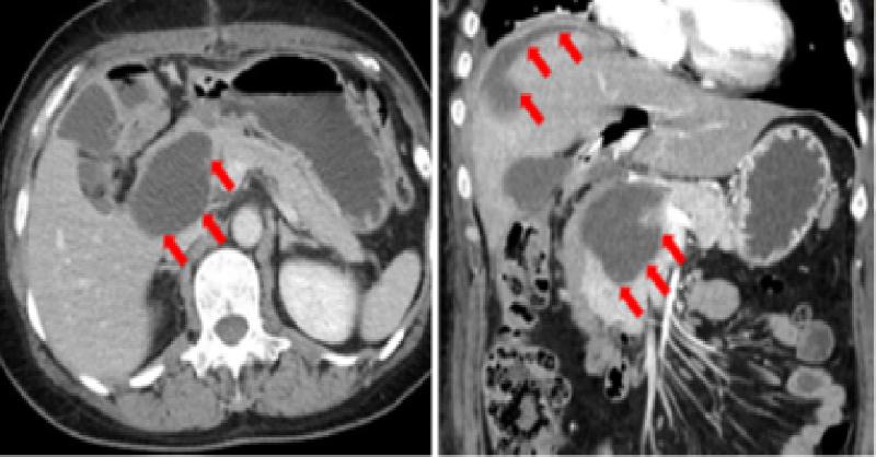Pancreatic Fistula Following Extrahepatic Bile Duct Resection: Management