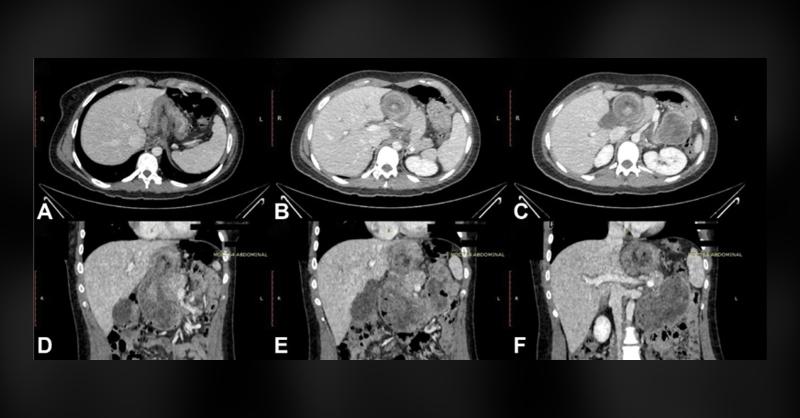 A Rare Case of Gastric Volvulus after Bariatric Surgery