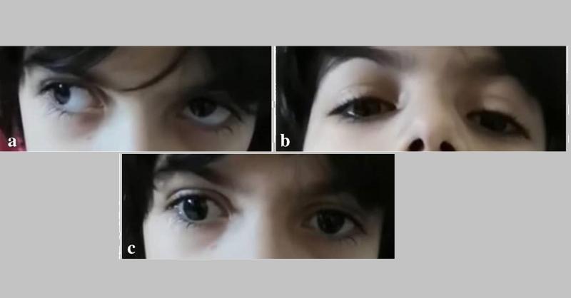 Case of Bilateral hypotropic dissociated vertical deviation