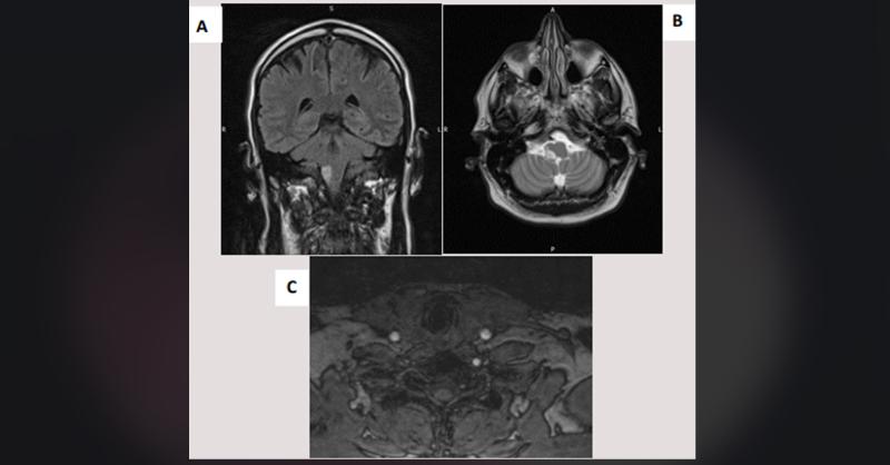 Delayed Diagnosis of Traumatic Vertebral Artery Dissection  after La Tomatina Festival 