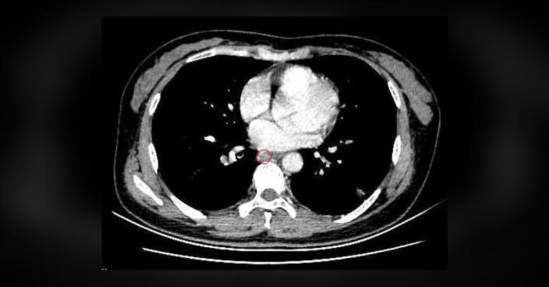 Diagnosis of Right Lung Nodules and Mediastinal Mass