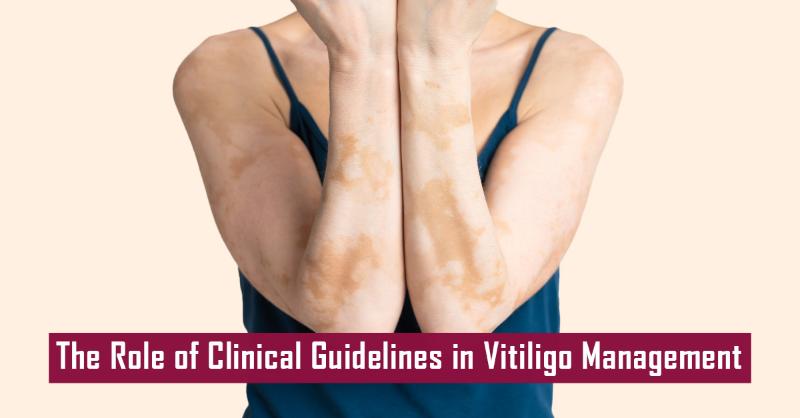 Comprehensive Guidelines for Managing Vitiligo: A Path to Better Care