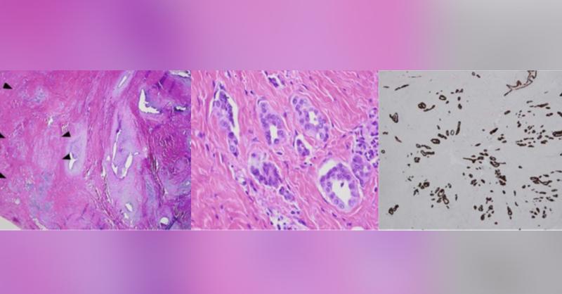 <p>Patient Presented with Abdominal Wall Soft Tissue Finding</p>
