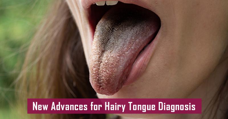 Diode Laser: A New Hope for Black Hairy Tongue