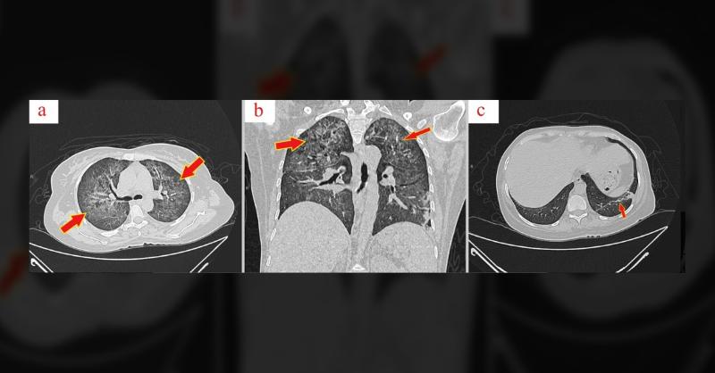 <p>Diagnosis of a Rare Platelet Disorder in a 39-Year-Old Woman</p>