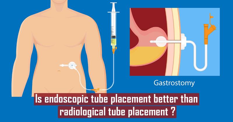 Which is better, Endoscopic or Radiological Gastrostomy Tube Placement?