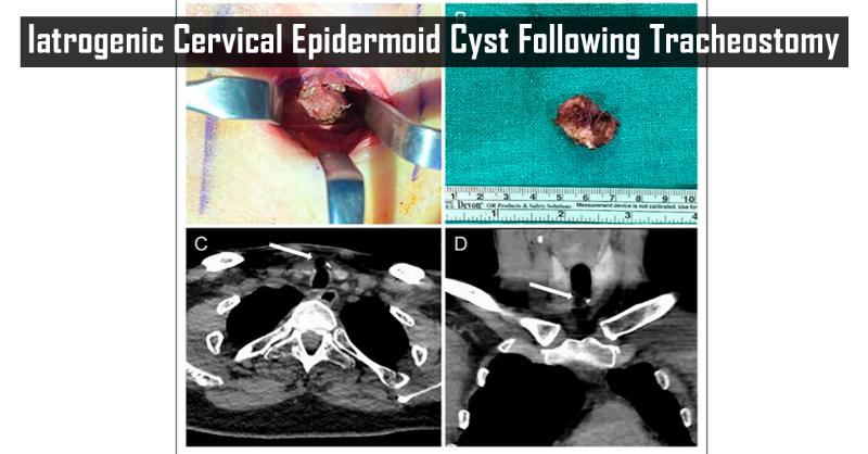 Iatrogenic Cervical Epidermoid Cyst Following Tracheostomy