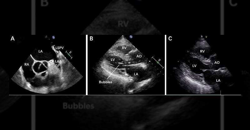 <p>Left Atrial Appendage Closure: Simplified Procedure and Unforeseen Challenges</p>