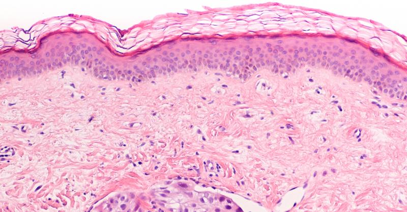 Sentinel Lymph Node Biopsy in Carcinoma Breast