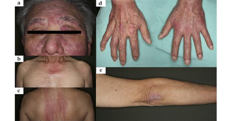 Rare Case of Clinically Amyopathic Dermatomyositis in an Elderly Male Patient