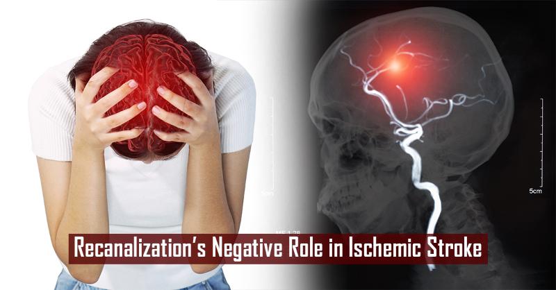 Cerebral Ischemia-Reperfusion Injury in Acute Ischemic Stroke Treatment