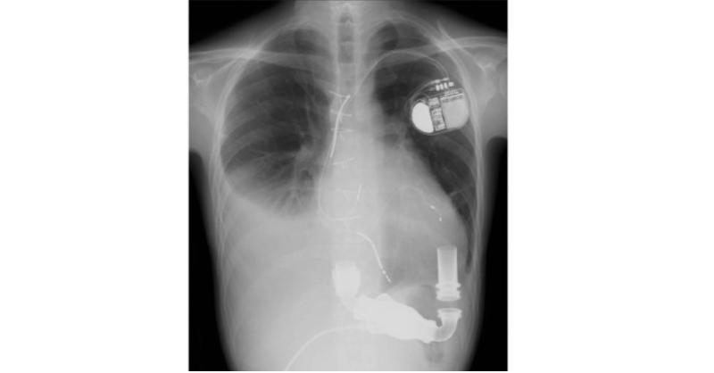 Right Heart Failure after Left Ventricular Assist Device Implantation in a 30-Year-old Man