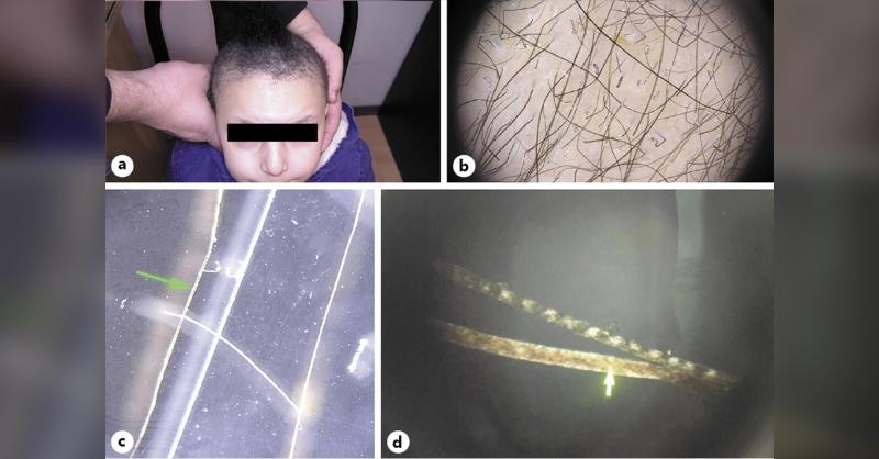 Trichothiodystrophy in a 5-year-old boy 