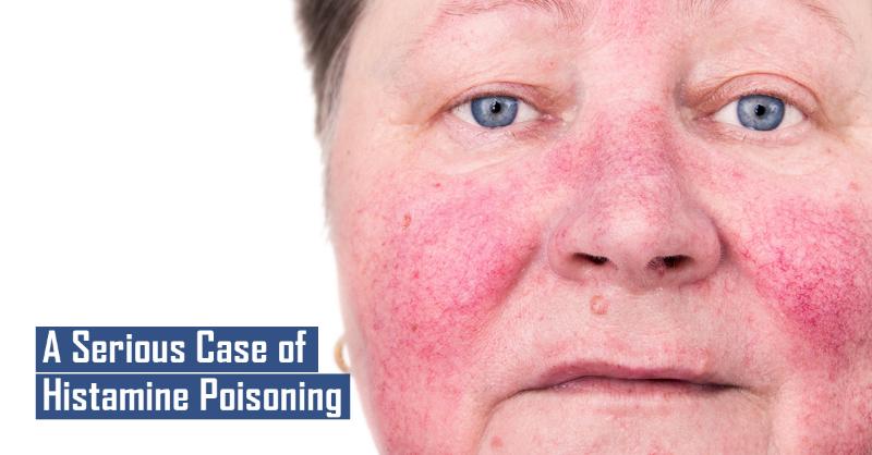 <p>A Serious Case of Scombroid Toxicity</p>