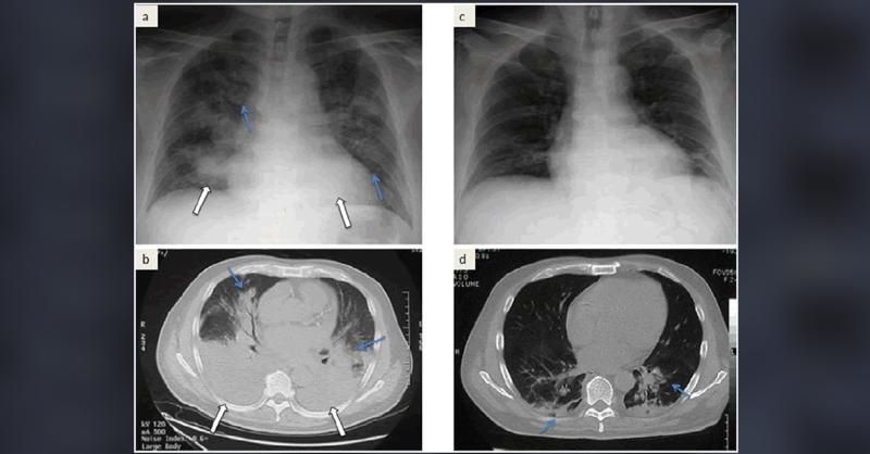 Acute Promyelocytic Leukemia In An Adult Male With Unusual Radiological Findings