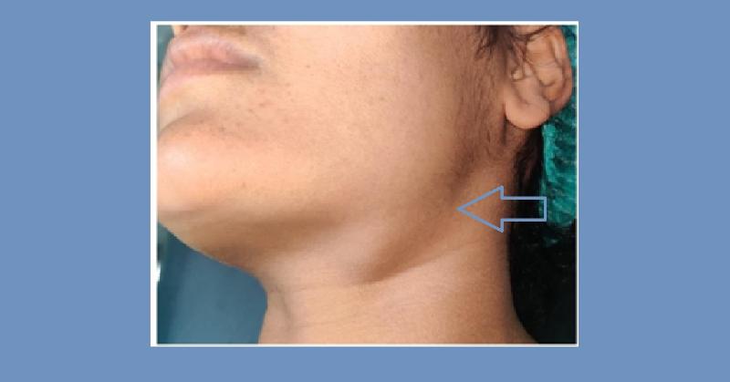 <p>Epidermoid Cyst of Submandibular Region: An Unusual Site for Occurrence</p>