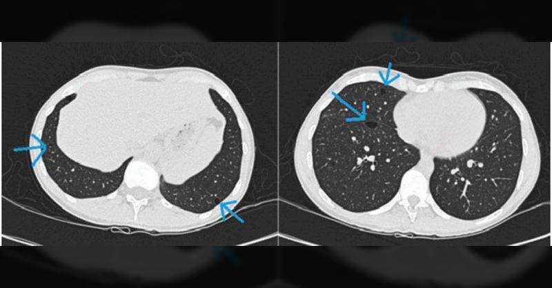 <p>"Genetic Whispers: Decoding the Clues Behind Spontaneous Pneumothorax and Basal Lung Cysts"</p>