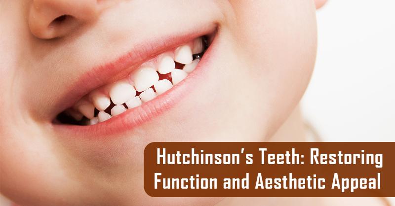 Understanding and Treating Hutchinson’s Teeth: A Comprehensive Approach