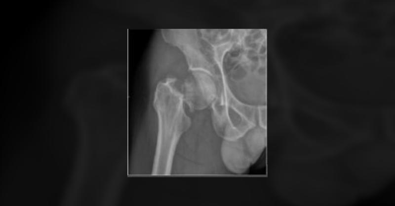 <p>Direct Anterior Approach with Femoral Neck System for Irreducible Displaced Femoral Neck Fractures</p>