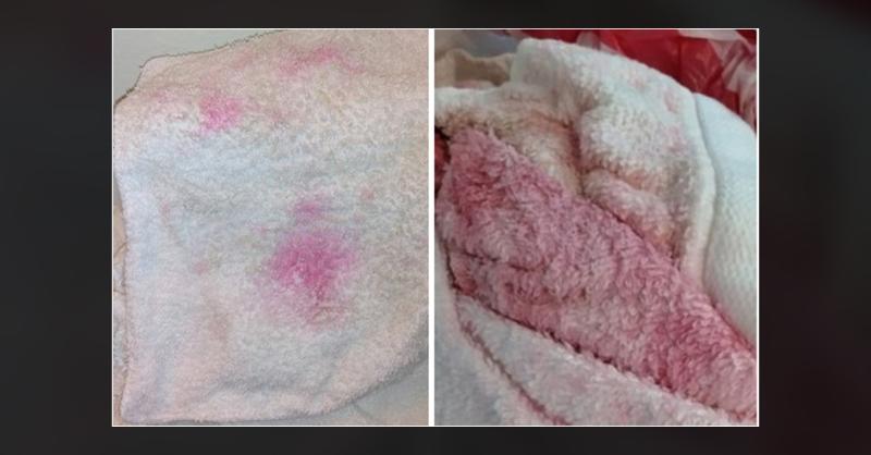 <p>What Treatment Do You Suggest in This Case Of Pseudochromhidrosis?</p>
