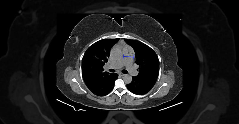 Diagnosis of Atrial Septal Defect and Thyroid Autoimmunity in a Middle-Aged Woman