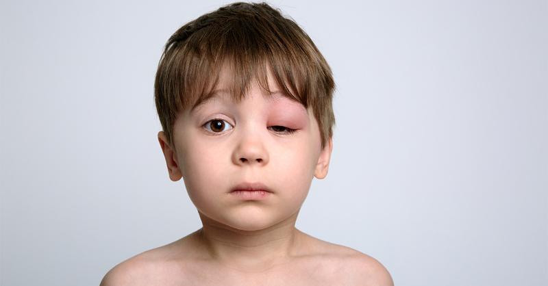 <p>8-year-old Boy presented with Swollen Eyelid</p>