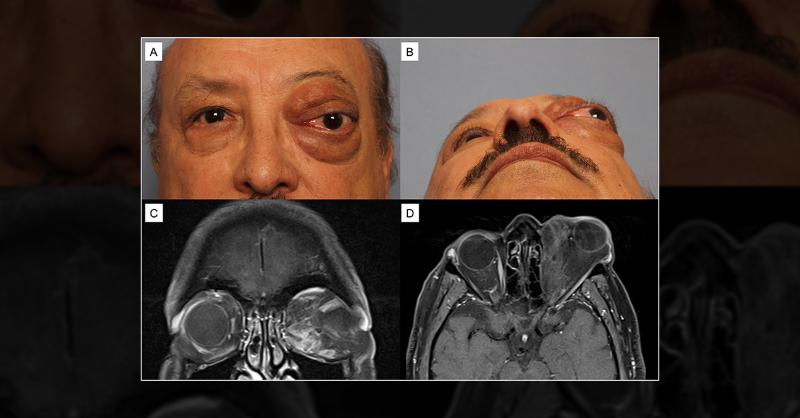 <p>Seeking Treatment For 18 Years of Left Eye Ptosis and Underlying Liposarcoma</p>