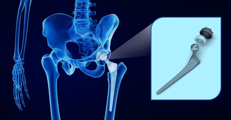 Reverse Total Shoulder Arthroplasty with Glenoid Bone Graft