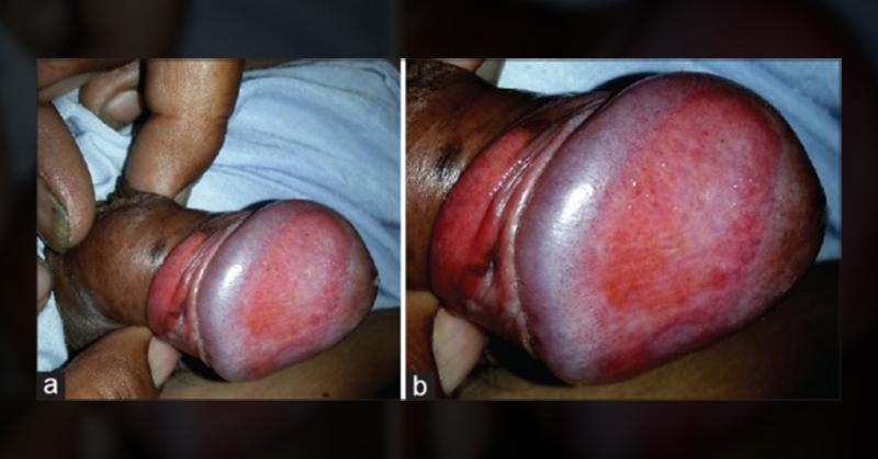 Plasma Cell Balanitis Clinical Insights and Management