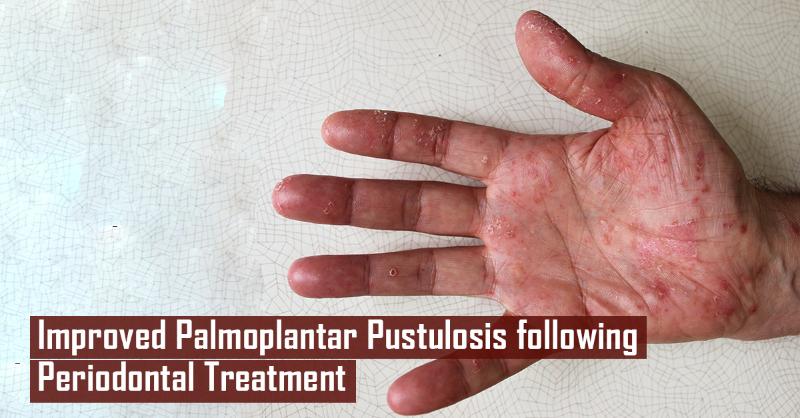 Improved Palmoplantar Pustulosis Case in a 56-year-old Woman