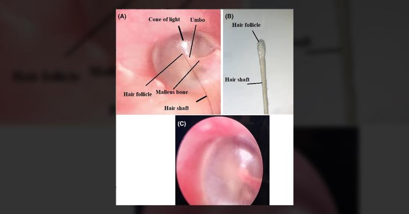 A Case of Oto-Tricho in the Tympanic Membrane
