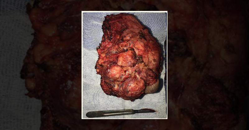 <p>A Case of Paratesticular Rhabdomyosarcoma</p>