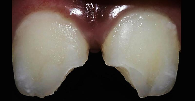 Case of restoration of anterior aesthetics using direct composite resin