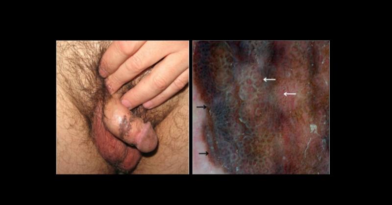 Diagnosis of Bowenoid Papulosis