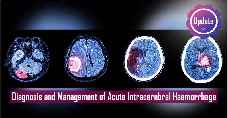 acute intracerebral haemorrhage: diagnosis and... Acute Intracerebral Haemorrhage: Diagnosis and Management | MedSynapse