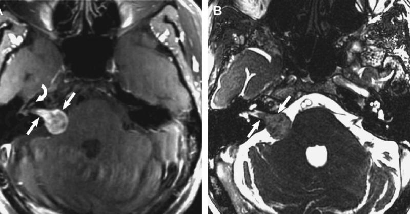 Cerebellopontine Angle (CPA) Tumor