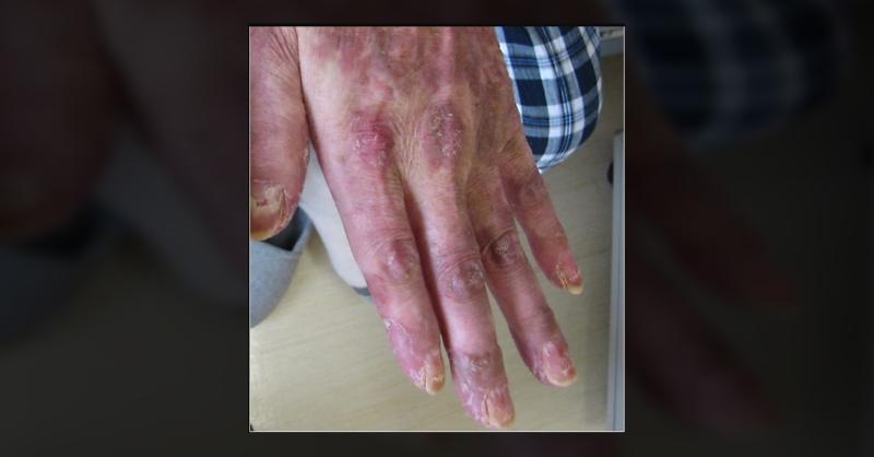 <p>Your Opinion on the Management of Bazex Syndrome</p>