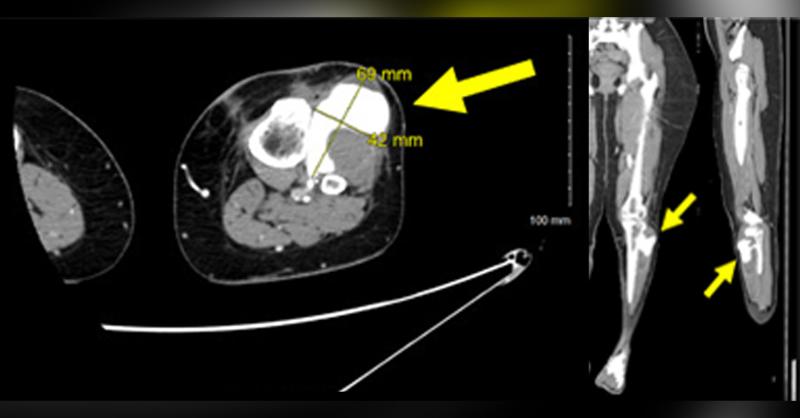Pseudoaneurysm in the Anterior Tibial Artery after Arthroscopic Anterior Cruciate Ligament Repair: A Case Study