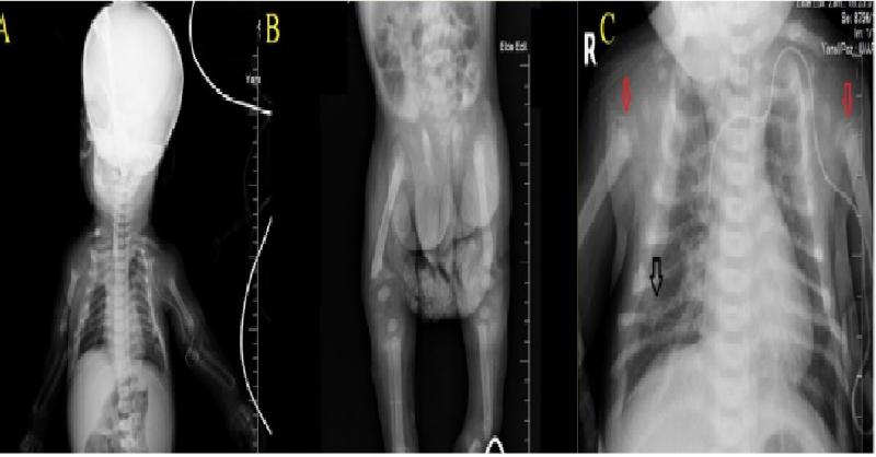 <p>Neonatal Severe Primary Hyperparathyroidism manifested with Severe Hypercalcemia and Metabolic Bone Disease in 7 months old Infant</p>