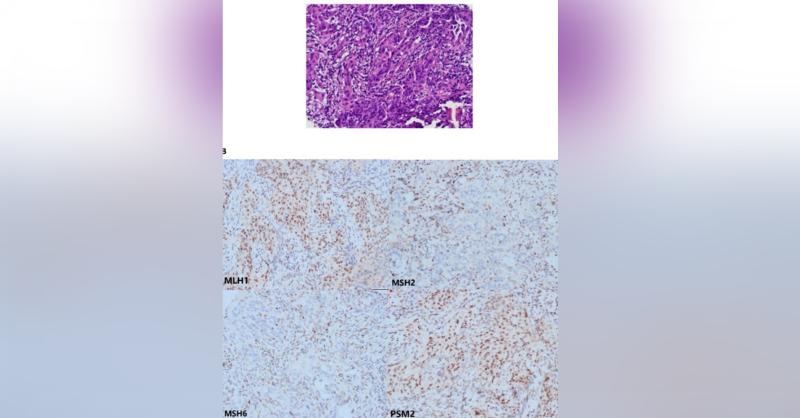 Endometrial Cancer in an Elderly Female Combined with EPCAM-MSH2 Deletion